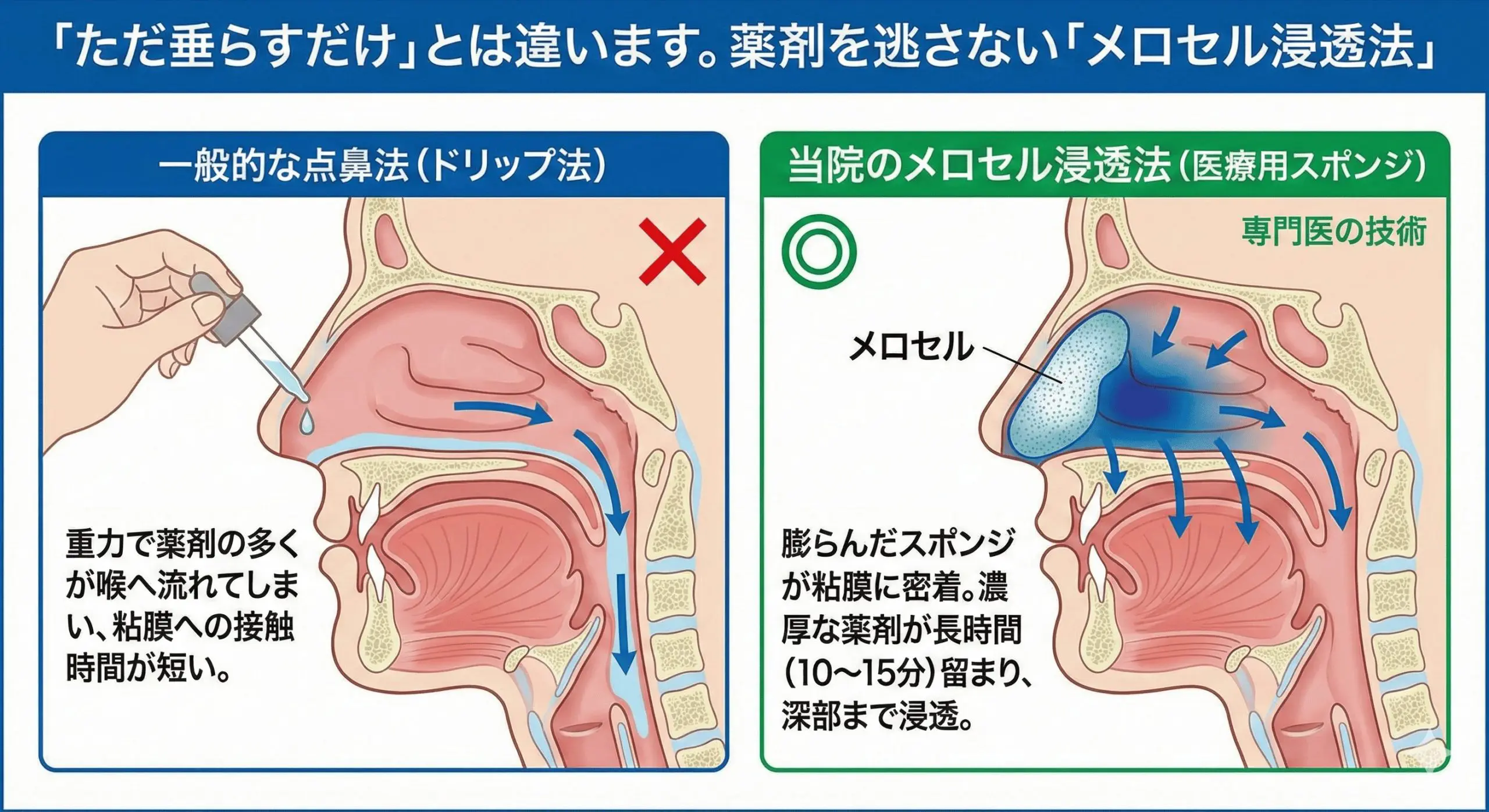 花粉症治療（自由診療）ボトックス｜眠気なし・即効性でつらい症状を